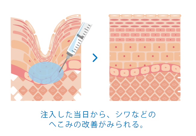 ヒアルロン酸リフト